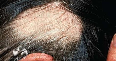 dermnet alopecia areata